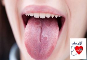 درمان برفک دهان بزرگسالان