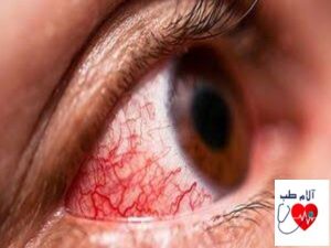 علت قرمزی چشم چگونه تشخیص داده می شود؟