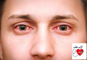 التهاب چشم  چیست؟