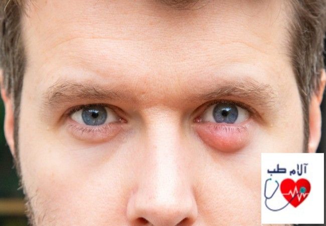 التهاب چشم چیست؟