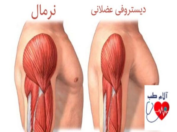دیستروفی عضلانی چیست؟